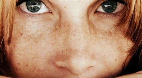 brown hair and freckles|why did my freckles disappear.